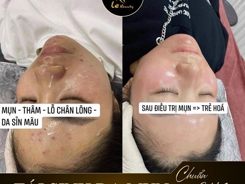 Nguyên nhân gây ra da mụn và giải pháp lấy lại làn da mịn màng, hiệu quả