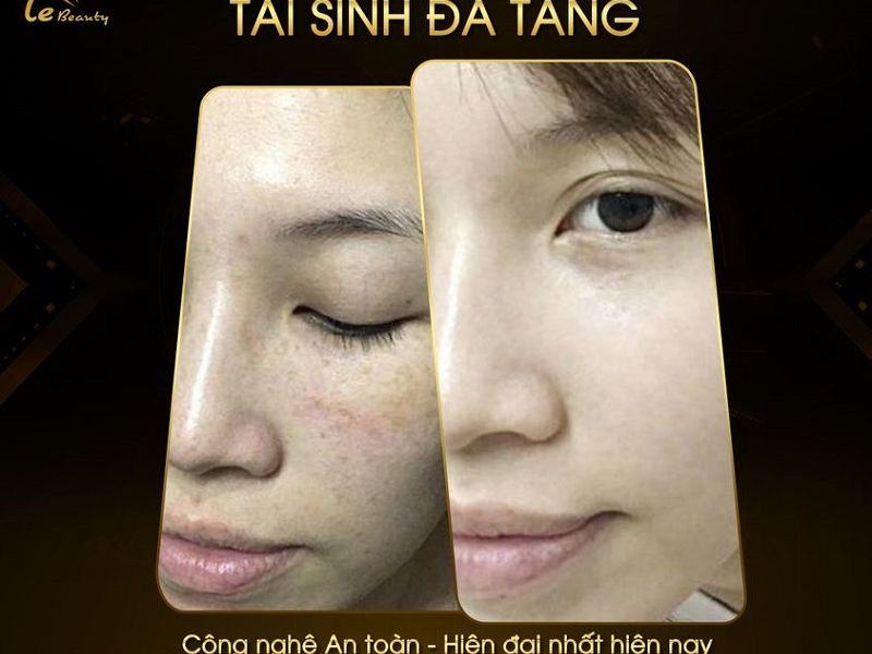 Nám da là gì? Nguyên nhân và cách điều trị nám hiệu quả