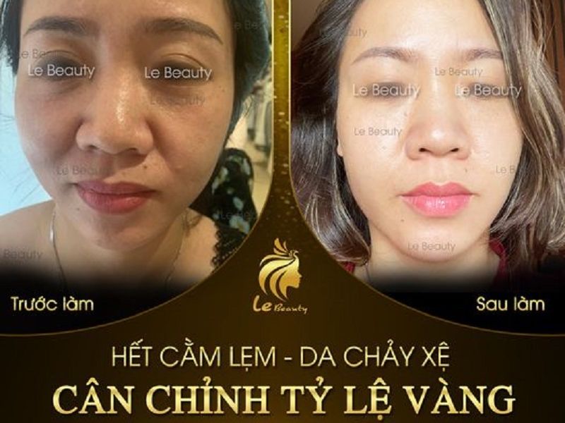 Định hình cân chỉnh khuôn mặt Le Beauty - Mặt lệch không còn là nỗi lo