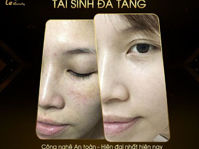 Nám sau sinh và phương pháp loại bỏ cơn ác mộng của chị em phụ nữ