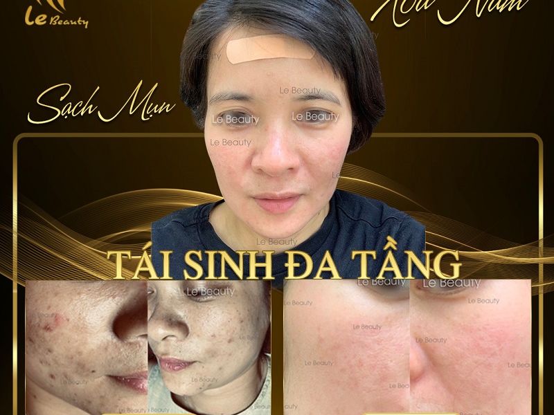 Trẻ hoá da tái sinh đa tầng giữ mãi nét thanh xuân