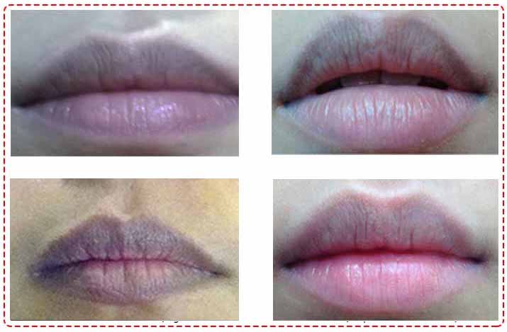 Viền môi bị thâm sau khi xăm Nguyên nhân  6 cách khắc phục